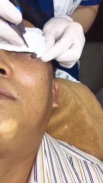 MỤN THỊT SIÊU TO‼Ngay gần mắt Phải làm sao