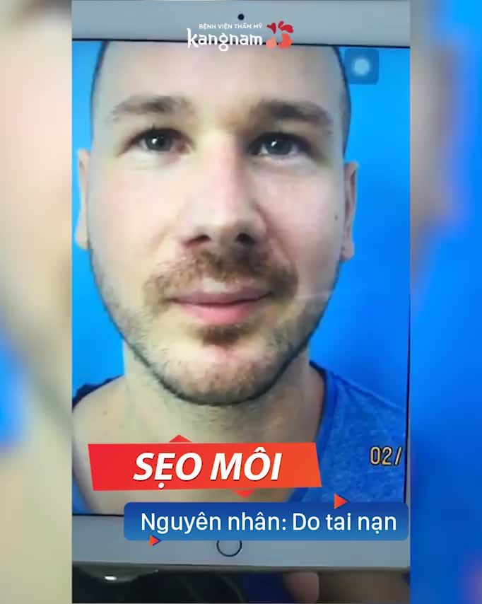 Khách hàng Úc SỬA SẸO MÔI - TẠO HÌNH MÔI ‼️Hóa Nam Thần