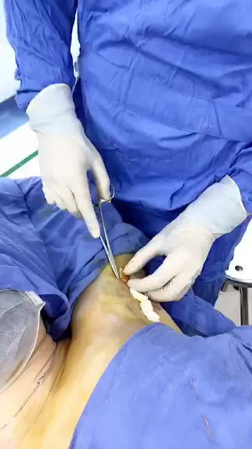 Quy trình băng ép - hút tuyến mồ hôi, khử hôi nách tại bvtm Kangnam