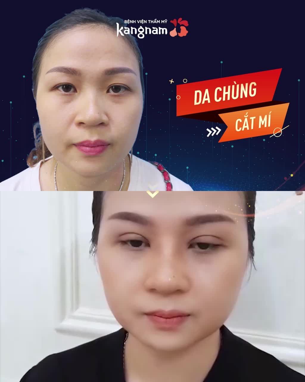 Mắt CHƯA ĐẸP Giải pháp THẨM MỸ MẮT nào PHÙ HỢP NHẤT VỚI BẠN