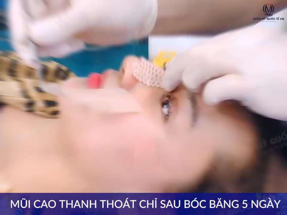 Combo nâng mũi + cắt mí HOT nhất VQ GIẢM TẬN 30%