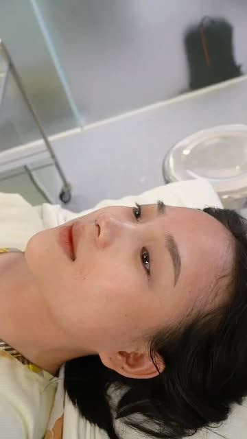 NÂNG MŨI CẤU TRÚC SURGIFROM TẠI DR.HOẠT ĐƯỢC NHIỀU KHÁCH HÀNG LỰA CHỌN