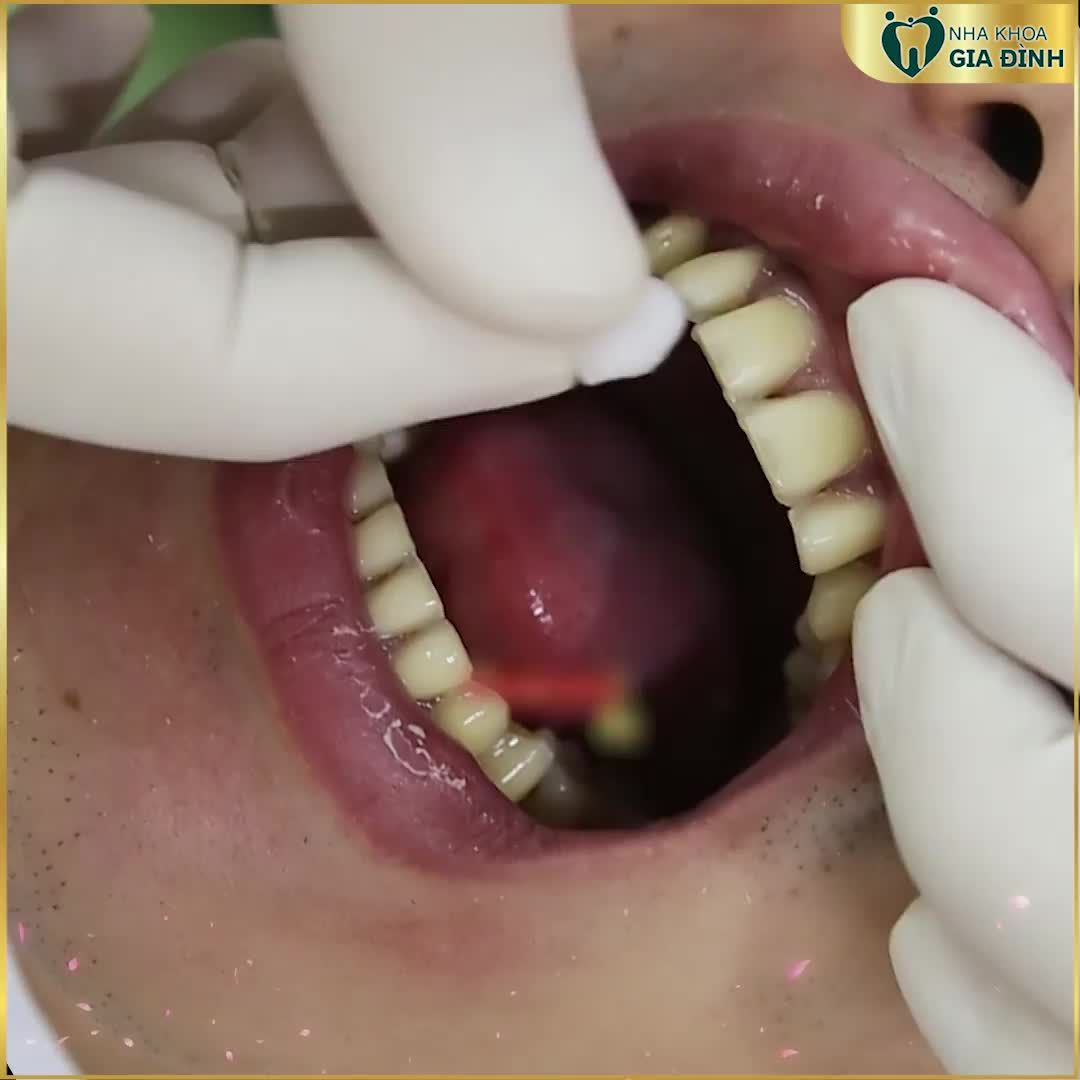 DÁN SỨ VENEER CHỈ TỪ 3TR/RĂNG – CƯỜI ĐẸP CHUẨN SOÁI CA NHƯ DIỄN VIÊN TRỌNG LÂN