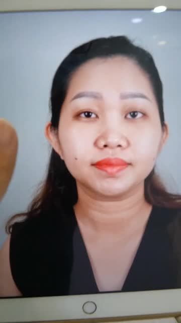 QUÁ ĐẸP CHO CA NÂNG MŨI CẤU TRÚC DR.HOẠT VỪA THỰC HIỆN XONG
