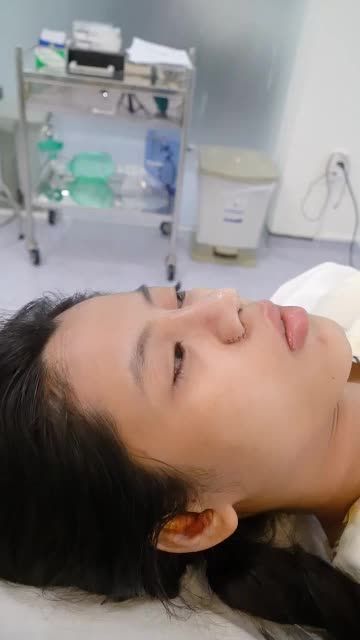 MŨI CẤU TRÚC VỪA THỰC HIỆN XONG - KHÔNG ĐAU, KHÔNG SƯNG BẦM