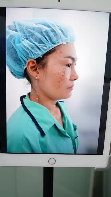 NÂNG MŨI BỌC SỤN - MANG ĐẾN GƯƠNG MẶT HÀI HOÀ TỈ LỆ CHUẨN