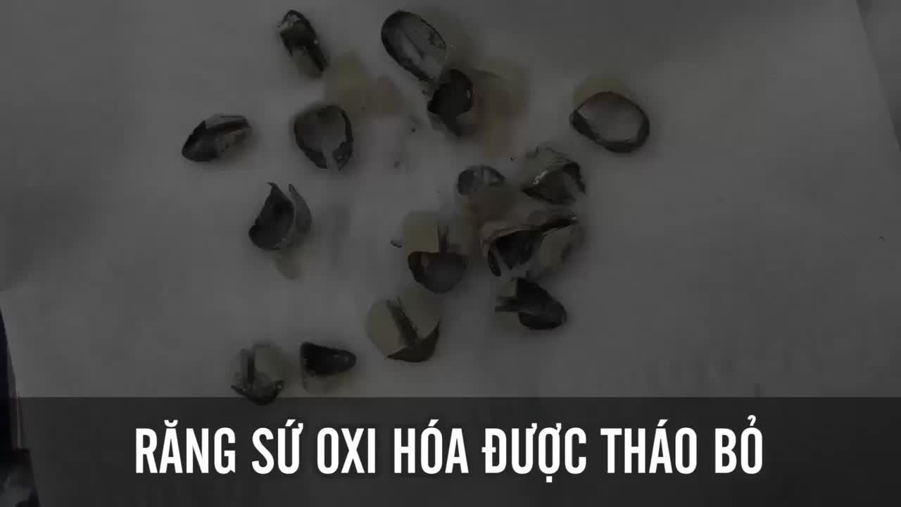 ĐÃ ĐẾN LÚC THAY ĐỔI RĂNG SỨ CŨ (KIM LOẠI) BẰNG RĂNG TOÀN SỨ