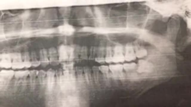 Nhổ R số 28 lệch má và R38 lệch 90 độ