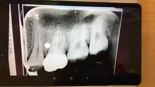 Nhổ răng khôn sâu, đau nhức cho chị Trang.