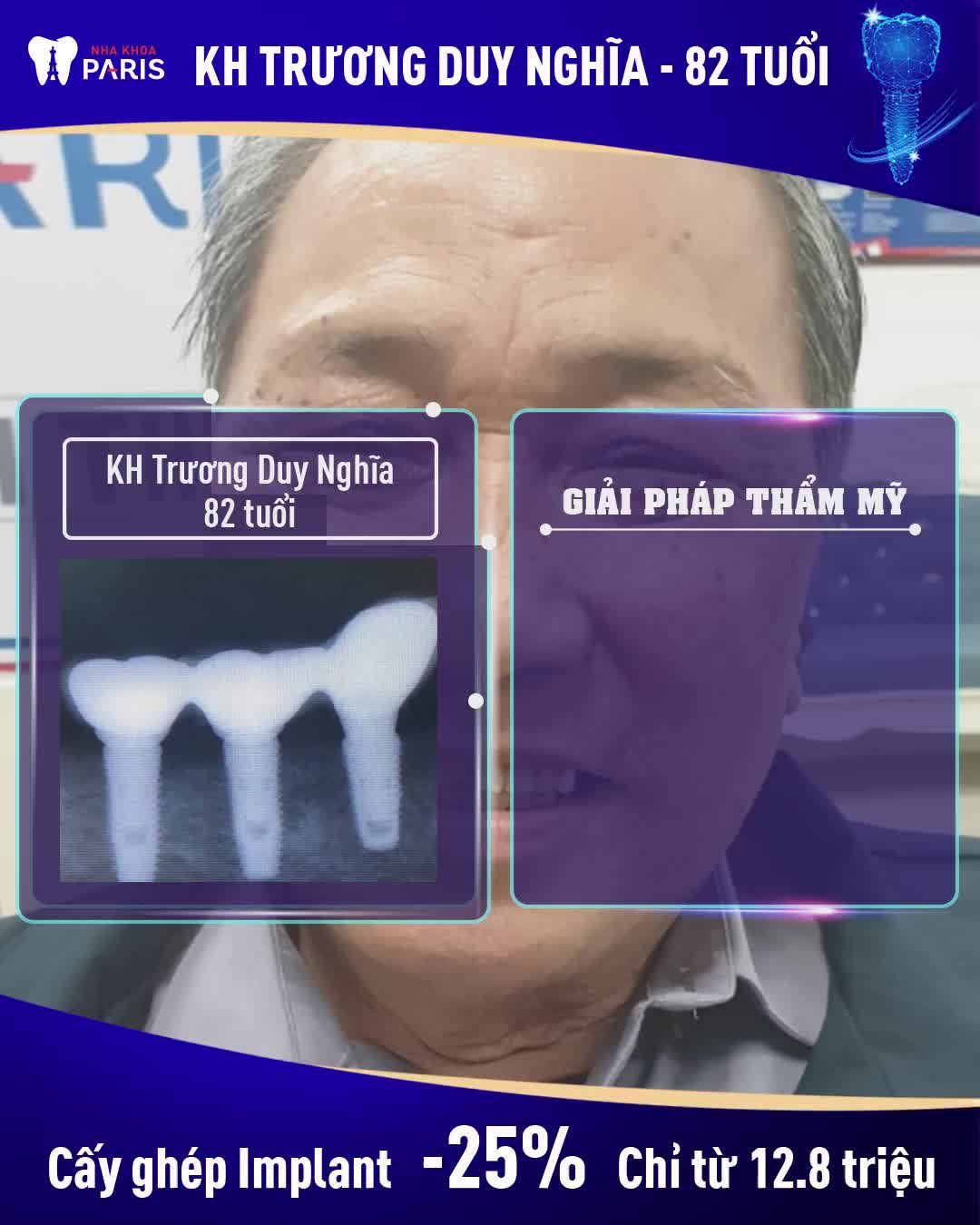 REVIEW CHÍNH XÁC NHẤT SAU TRỒNG RĂNG IMPLANT - KHÔI PHỤC RĂNG MẤT