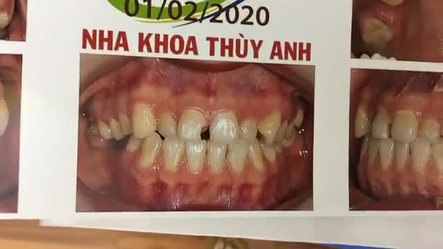 Gắn mắc cài cho bạn Chi