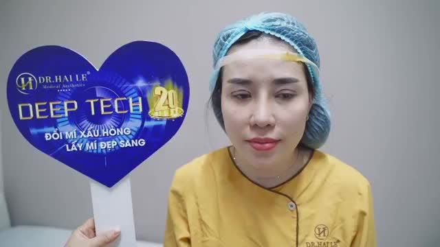 Đổi mí xấu hỏng, lấy mí đẹp sang chỉ sau 30 phút với công nghệ DEEP TECH20 độc quyền tại DR.HẢI LÊ!