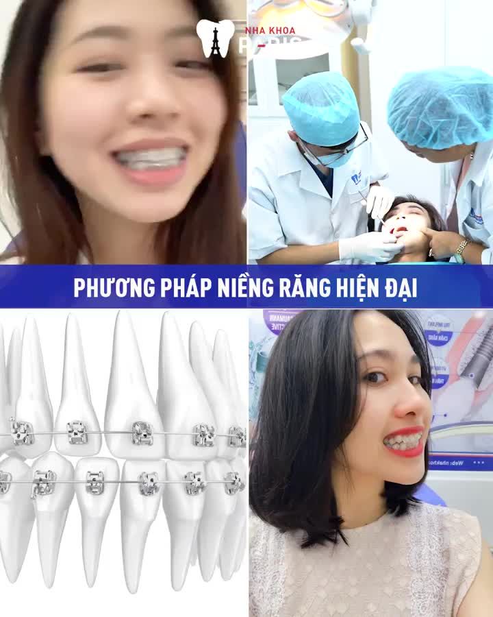 NIỀNG RĂNG HẾT HÔ - THƯA - MÓM - KHẤP KHỂNH