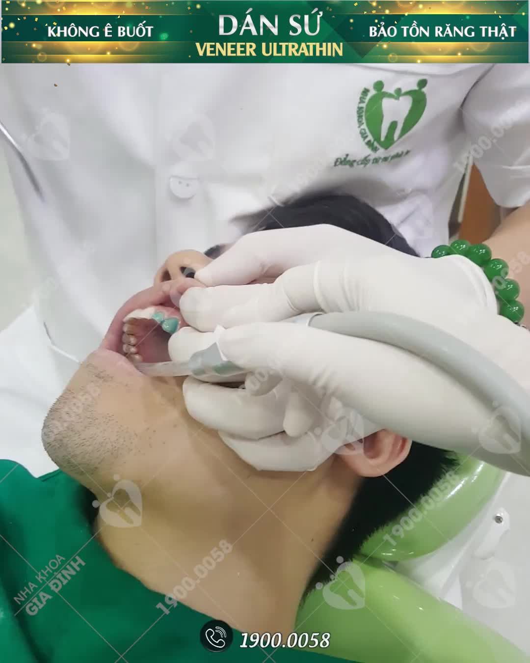 CẬN CẢNH DÁN SỨ VENEER TẠI NHA KHOA GIA ĐÌNH TRỰC TIẾP THỰC HIỆN BỞI BÁC SĨ TRÊN 15 NĂM KINH NGHIỆM