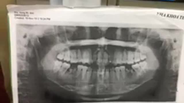 Cấy implant R46 cho bạn Kim Thư tại Nha Khoa Thuỳ Anh.