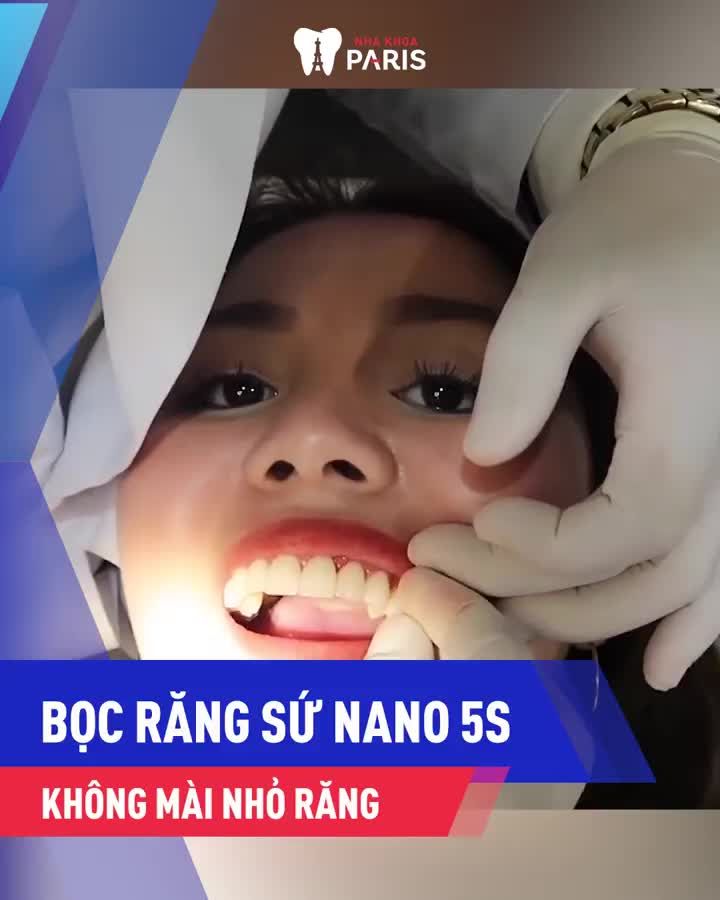 Răng Khấp Khểnh - Gãy Vỡ/Mất Răng - Hô Nhẹ Kém Duyên️
