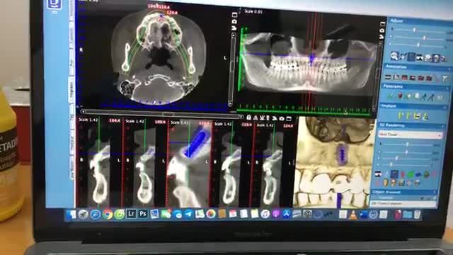 Cấy ghép chân răng nhân tạo cho chị Thương đến từ Tuyên Quang