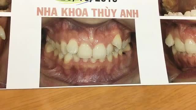 Gắn mắc cài cho bạn Mai Phương . Mắc cài sư thẩm mỹ