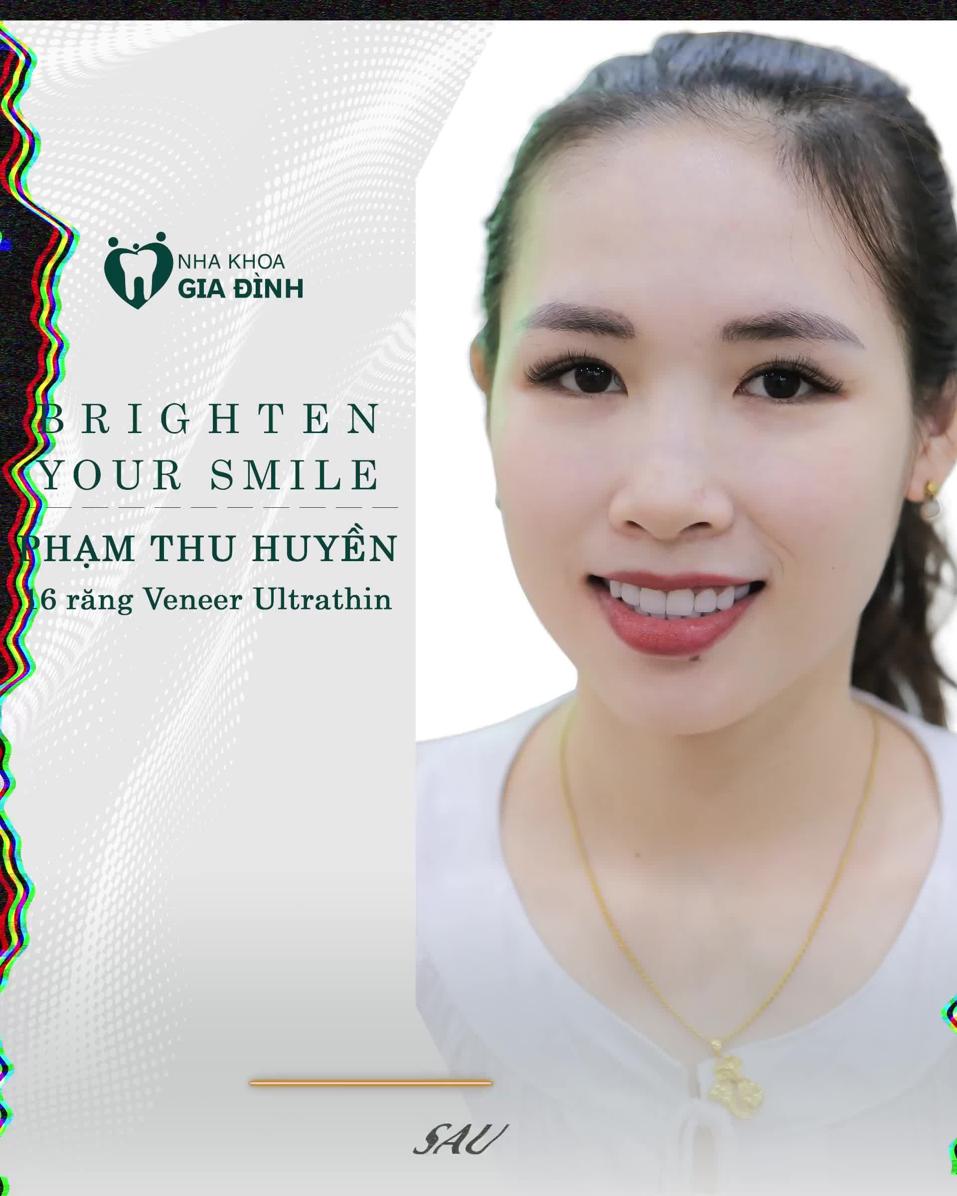 GIẢI CỨU HÀM RĂNG Ố VÀNG, THIẾU THẨM MỸ CHỈ SAU 2 LẦN HẸN