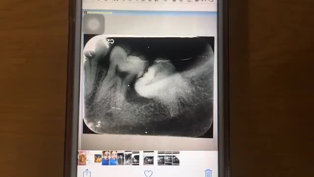 Nhổ răng khôn tại Nha Khoa Thuỳ Anh.