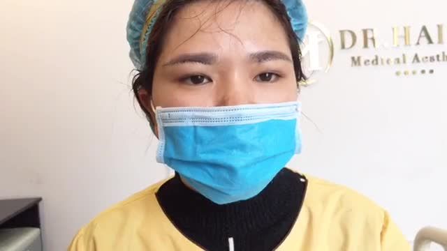 Kết quả nâng cung mày vừa thực hiện xong