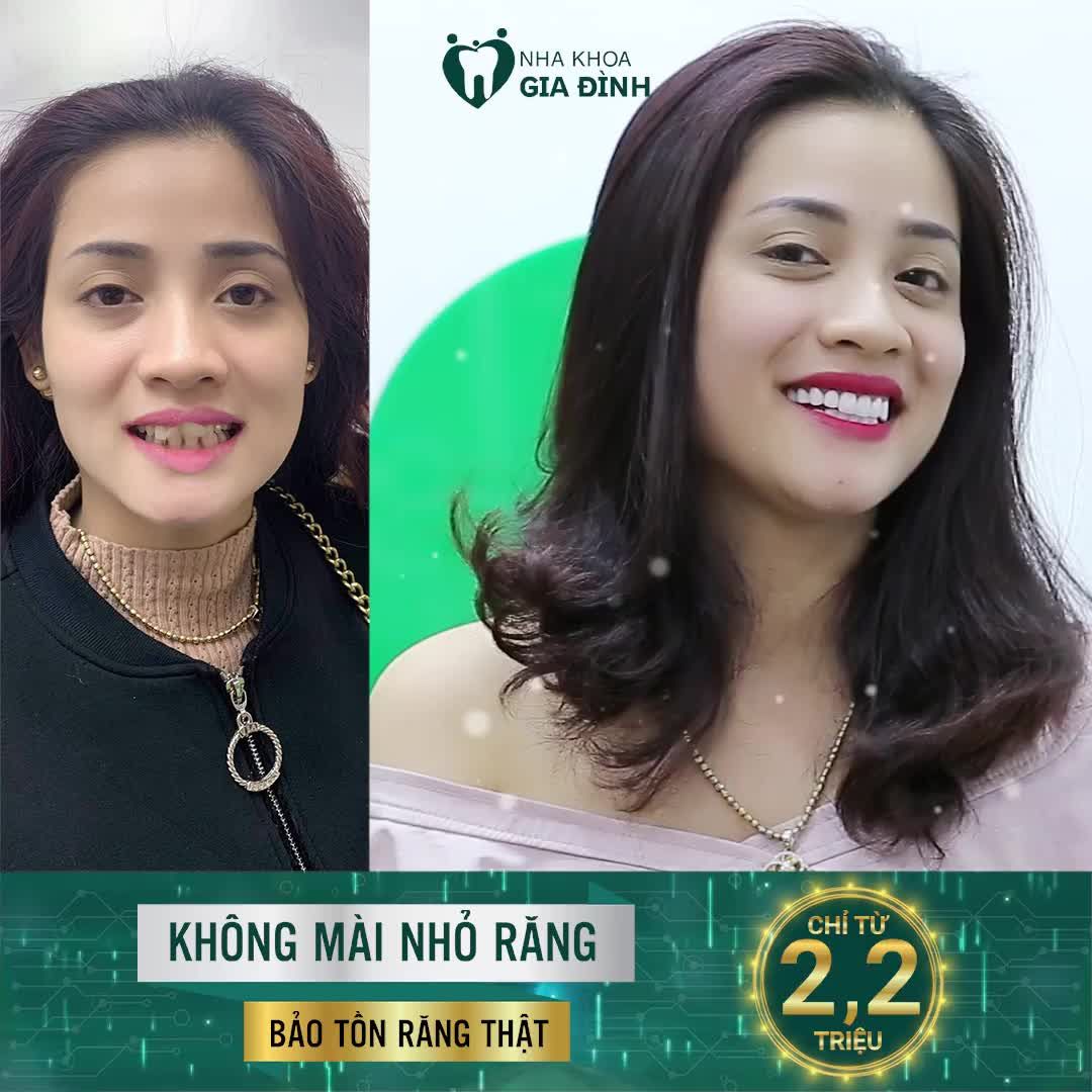 ƯU ĐÃI ĐẾN 50% DỊCH VỤ THẨM MỸ RĂNG (chỉ từ 2,2tr/răng)