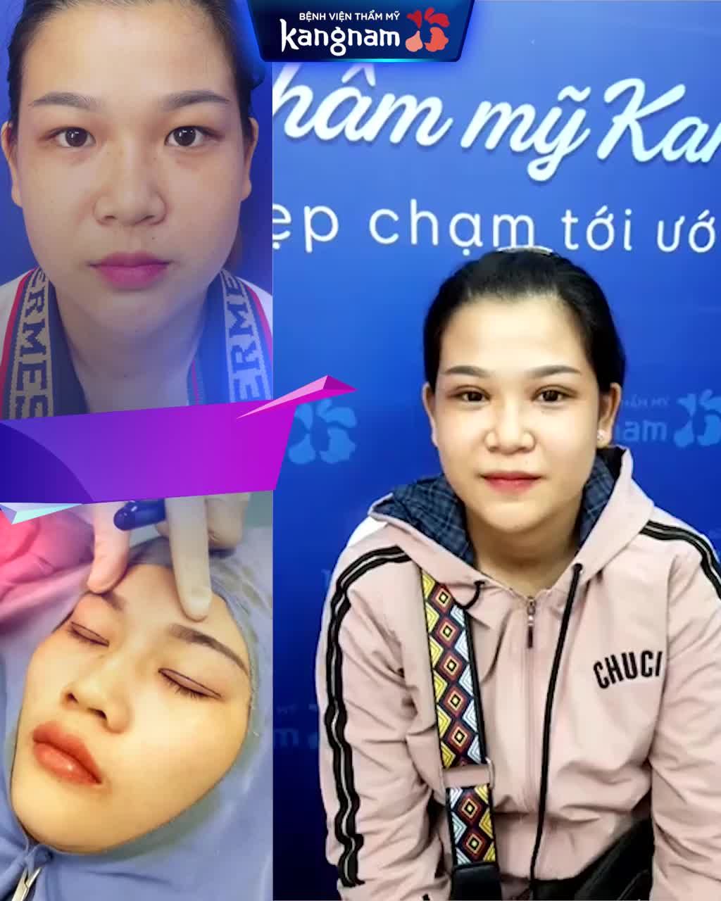 CẮT MÍ hóa HOTGIRL KHẨU TRANG Chỉ với 6.3 TRIỆU