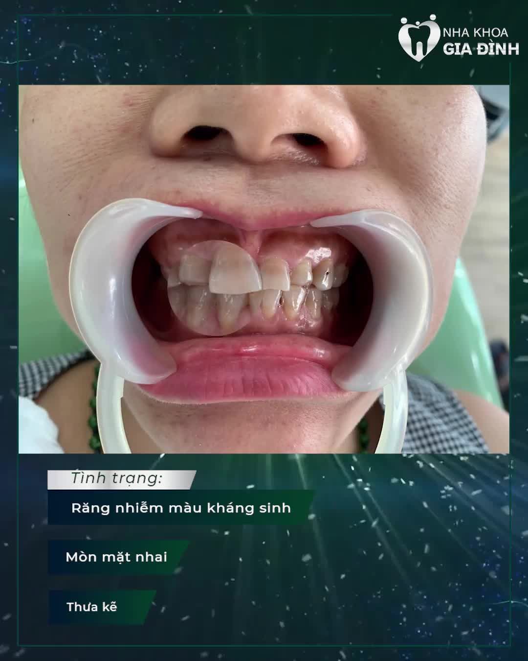 THẨM MỸ RĂNG TRONG MÔI TRƯỜNG SẠCH KHUẨN – SỞ HỮU NỤ CƯỜI ĐẸP CHUẨN AN TOÀN