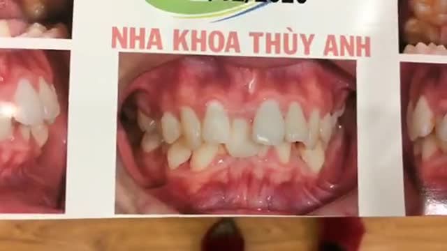Gắn mắc cài chỉnh răng lệch lạc nặng cho bạn vũ tại Nha Khoa Thùy Anh.