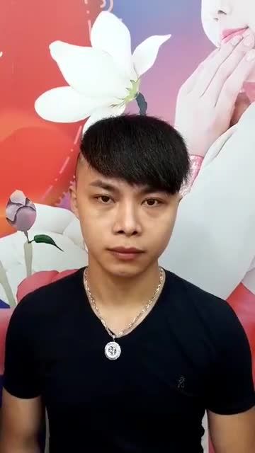 Kh nâng mũi sline 4D nanofom chỉnh xương,má lúm 1 bên,cắt mí dưới ghép mỡ,tái khám 1 năm.