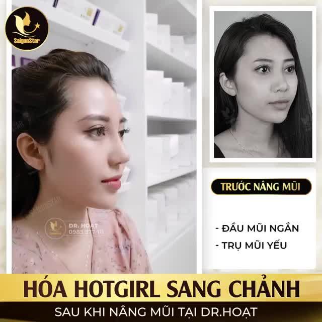 HÓA HOTGIRL SANG CHẢNH SAU KHI NÂNG MŨI TẠI DR.HOẠT