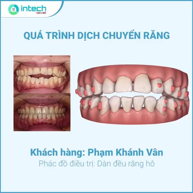 RĂNG HÔ THAY ĐỔI TUYỆT VỜI VỚI INVISALIGN