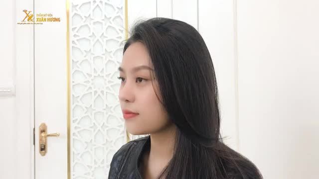 TÁI KHÁM SAU 4 THÁNG NÂNG MŨI, DÁNG TỰ NHIÊN ĐẾN NỖI NHIỀU NGƯỜI KHÔNG NHẬN RA DẤU VẾT THẨM MỸ