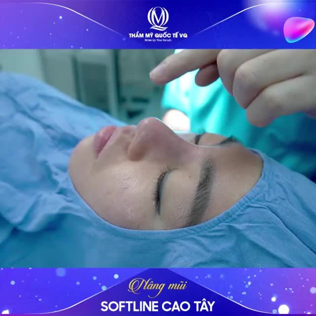 Mũi SOFTLINE - ĐỘC QUYỀN của Dr Vũ Quang có gì ĐẶC BIỆT