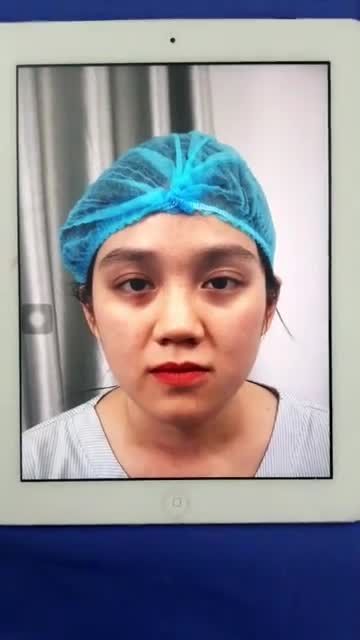 Ca nâng mũi softline đã từng tiêm filler trước đó mời cả nhà cùng xem kết quả cùng bác sĩ