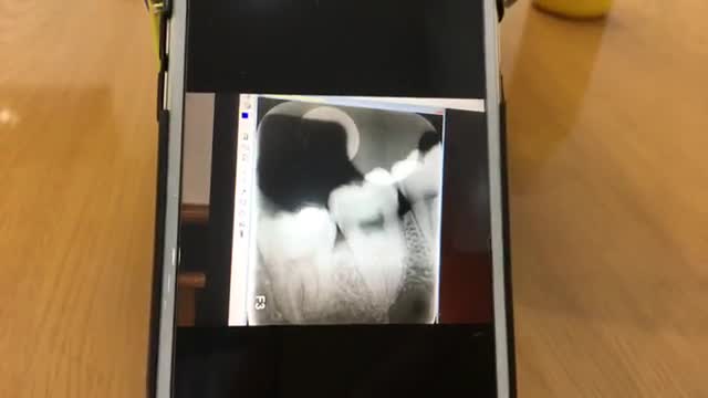 Nhổ răng khôn mọc ngầm.