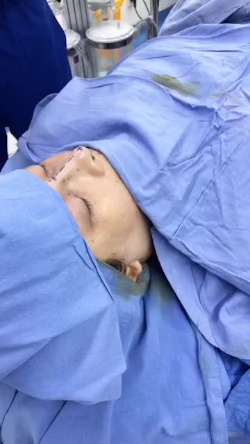 Bác sĩ phân tích dáng mũi sụn sườn sau khi làm dịch vụ