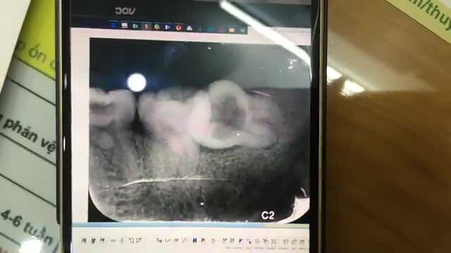 Nhổ răng khôn lệch 90 độ gây đau nhức cho anh Tú tại Nha Khoa Thuỳ Anh.