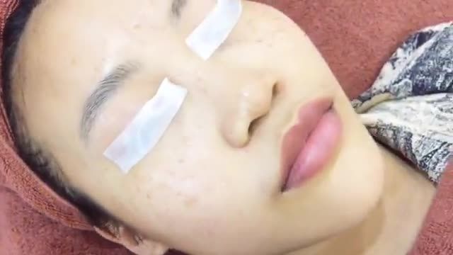 "Xóa sổ" tàn nhang hoàn toàn nhờ công nghệ Laser Spectra - Elos