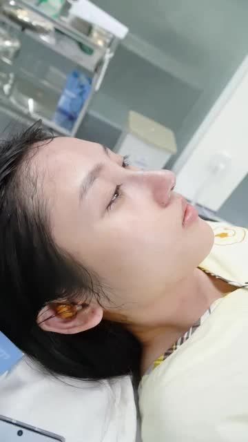 NÀNG XUÂN CỦA VIỆN: NÂNG MŨI CẤU TRÚC SỤN SURGIFORM VỪA THỰC HIỆN XONG