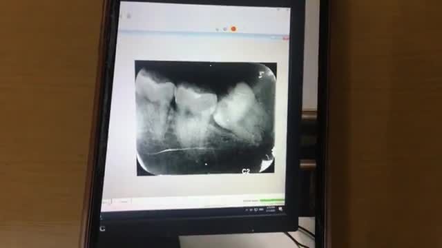 Nhổ răng khôn mọc lệch tại Nha Khoa Thuỳ Anh.