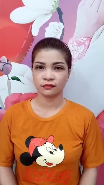 Khách hàng cắt mí trên plasma sau 5 ngày cắt chỉ