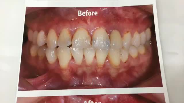 Lắp răng sứ cải thiện răng sâu kẽ, lệch lạc nhẹ cho chị Lan.