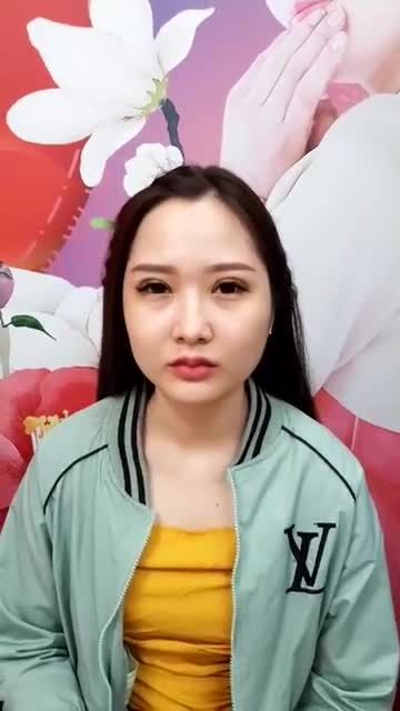 Khách hàng cắt mí trên plasma cũ tái khám được 1 tháng.