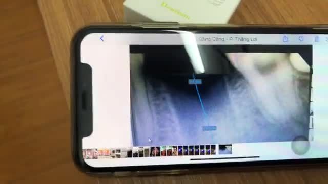 Cấy ghép chân răng nhân tạo Implant cho bạn Khánh Ly tại Nha Khoa Thuỳ Anh.