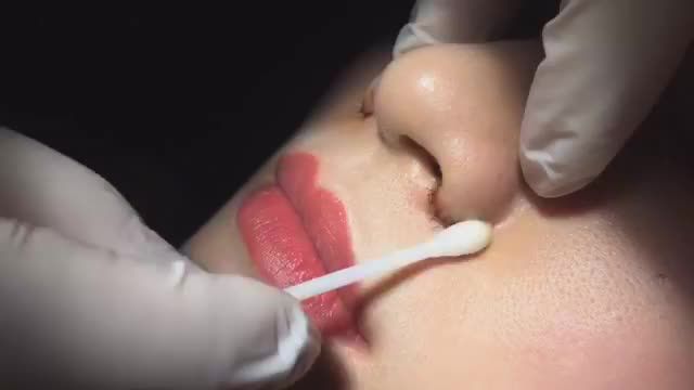 Cùng xem quy trình cắt chỉ thu cánh mũi sau khi 7 ngày tại Dr.Hải Lê