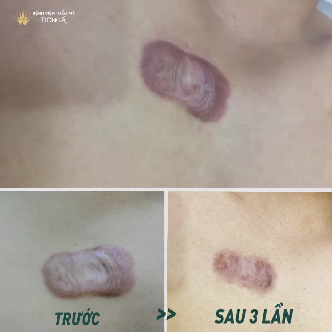 SẸO LỒI CỠ MẤY  XẸP NGAY CHỈ SAU 1 LIỆU TRÌNH
