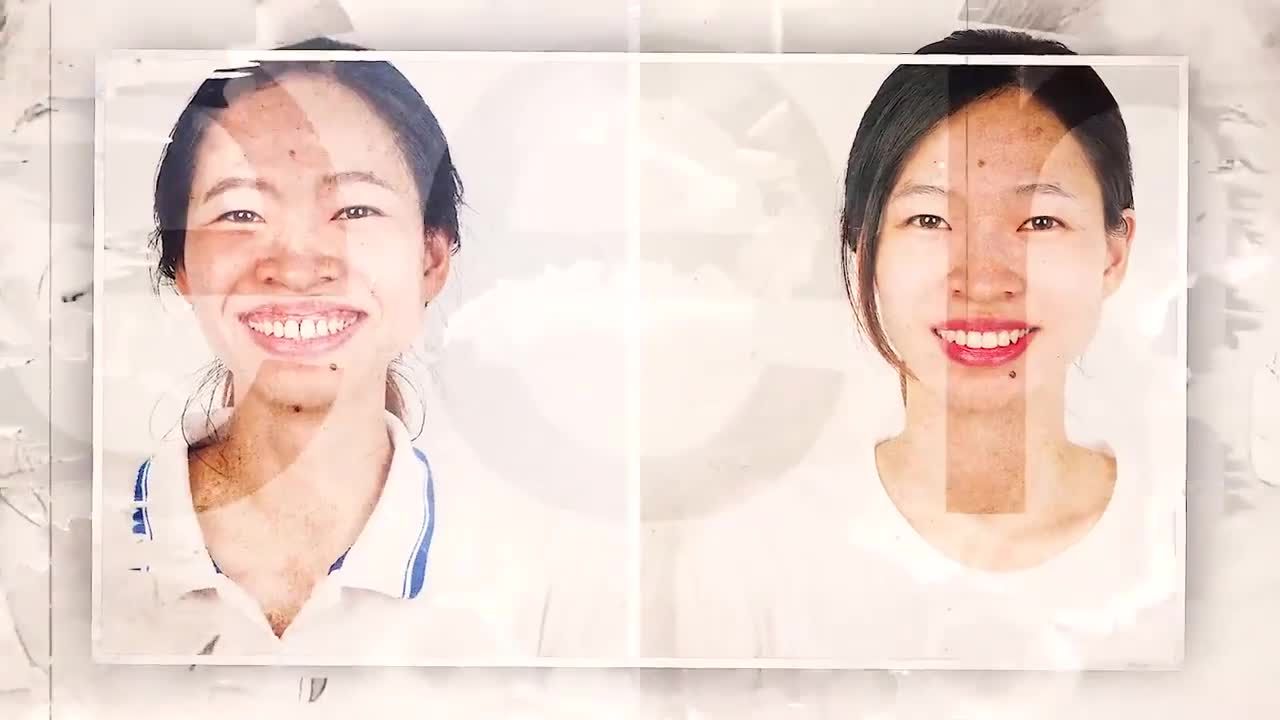 DÁN SỨ VENEER ĐÓNG KHE THƯA - GIÚP BẠN TRỞ NÊN TỰ TIN HƠN