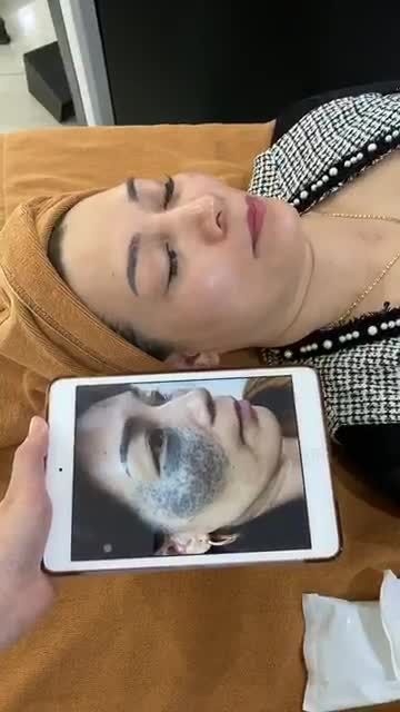 Cải thiện HOÀN TOÀN tình trạng Bớt Ota bẩm sinh với công nghệ Laser PICOWAY