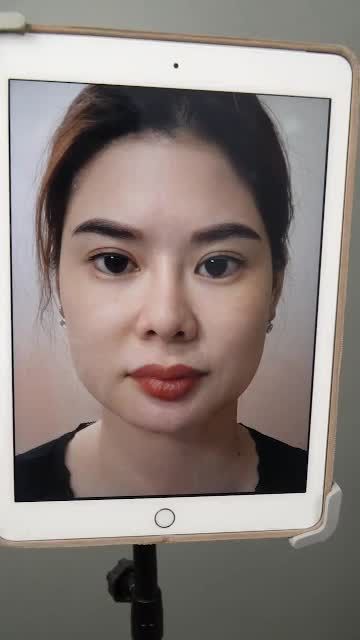 ĐẦU XUÂN TRỞ LẠI TÁI KHÁM SAU 10 NÂNG MŨI CẤU TRÚC SỬA LẠI